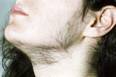 hairy teenage|Adolescent Hirsutism .